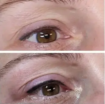 Close-up view of a human eye before (top) and after (bottom) blepharoplasty, showcasing the remarkable reduction of excess eyelid skin—a testament to luxury skincare.